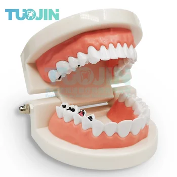 Модел на зъби Зъболекарски стандартния Модел на устната Кухина Модел Патология на зъбния кариес Модел на Обучение Демонстрация на детската градина Набор от Инструменти За Почистване на зъбите